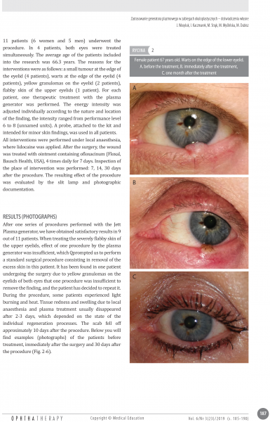 Jaromir Wasyluk - Plasma generator use in oculoplastic surgery: own experience 4_AJ.png