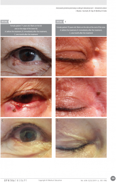 Jaromir Wasyluk - Plasma generator use in oculoplastic surgery: own experience 6_AJ.png