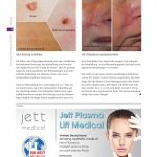 Ästhetische Dermatologie Jett-Plasma-Lift-Medical-in-german-media-page-003-150x150.jpg