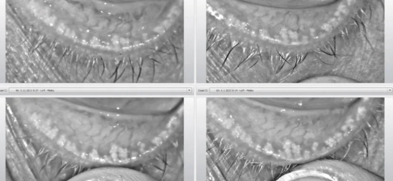 A safe and effective non-ablative treatment with multiple applications for the ocular surface ophtalmology-times-article-3.png